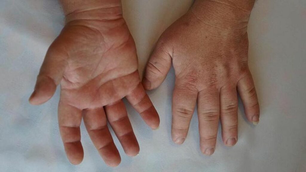 Acromegalia: así puede reconocer esta enfermedad que genera cambios en las extremidades y el rostro