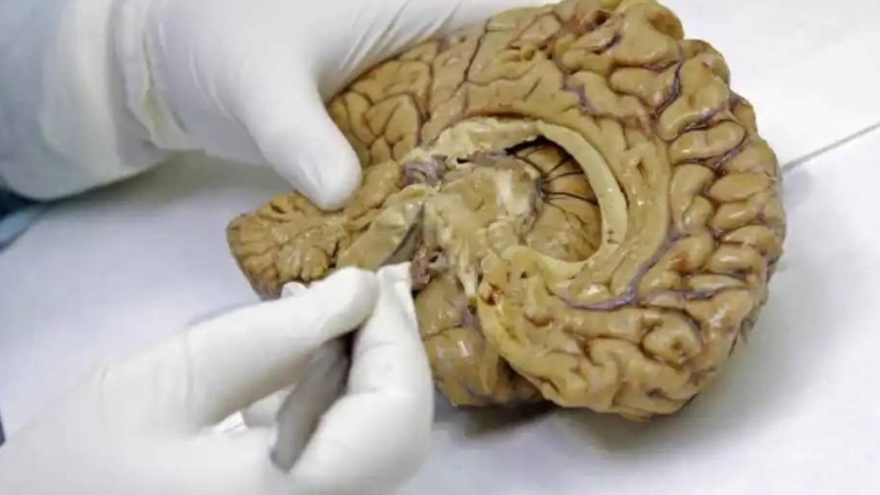 ¿Alzheimer por contagio? Investigadores detectaron estos 5 casos