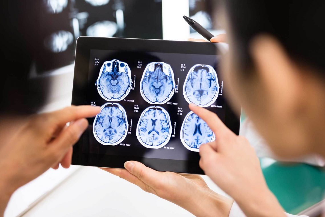 Tenga cuidado: si presenta este síntoma, podría ser un indicio de un tumor cerebral. Así se siente