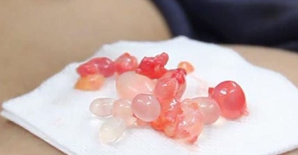 Biopolímeros: ¿qué son y por qué es tan caro retirarlos del cuerpo?