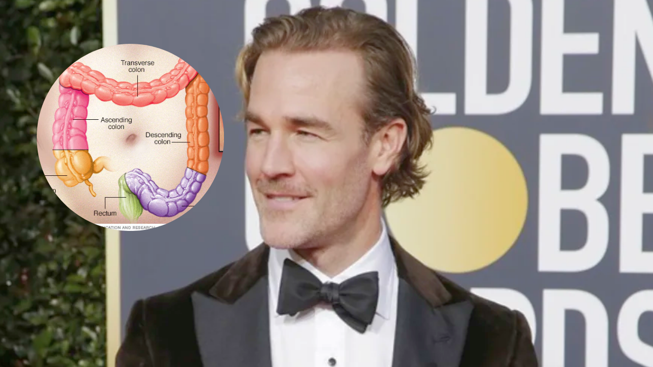 Los silenciosos síntomas del cáncer de colon, enfermedad por la que murió estrella de Hollywood