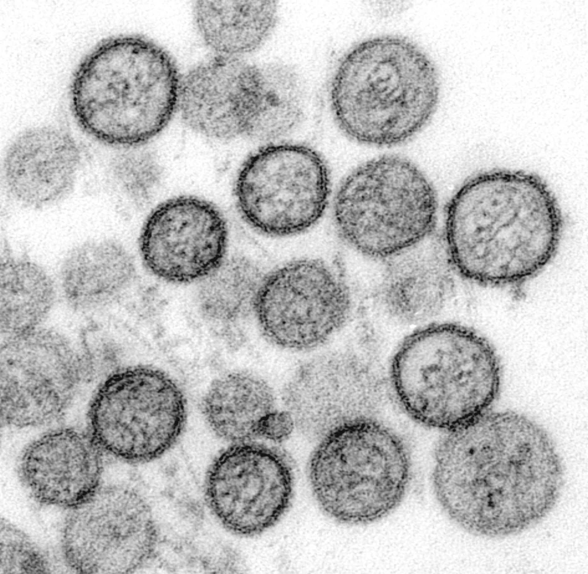 ¿El hantavirus se transmite entre personas? Esto es lo que debe saber sobre el brote actual