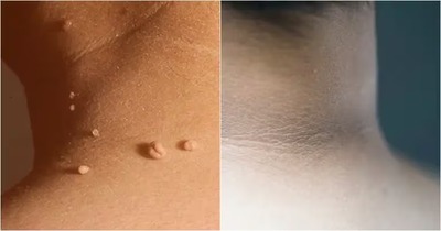 Síntomas de resistencia a la insulina 