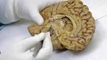 ¿Alzheimer por contagio? Investigadores detectaron estos 5 casos