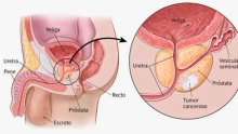 ¿Qué es el cáncer de próstata? Conozca los principales síntomas y su tratamiento