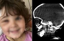 En España, médicos lograron extraer una aguja del cerebro de una niña de cuatro años: le contamos