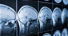 Científicos en China lograron revivir el tejido cerebral de un humano que llevaba congelado 18 meses