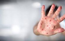 ¡Mucha atención! Así es como se contagia la viruela del mono: hay varias formas. Procure cuidarse