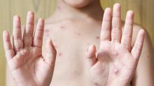 ¡Pilas! Estos son los síntomas de la viruela del mono: OMS ya emitió una alerta sanitaria mundial